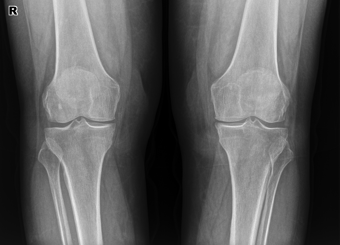 Рентген колена. Рекурвация коленного сустава рентген. Рентген здорового коленного сустава. Здоровый коленный сустав рентгеновский снимок. Рентгенограмма левого коленного сустава.